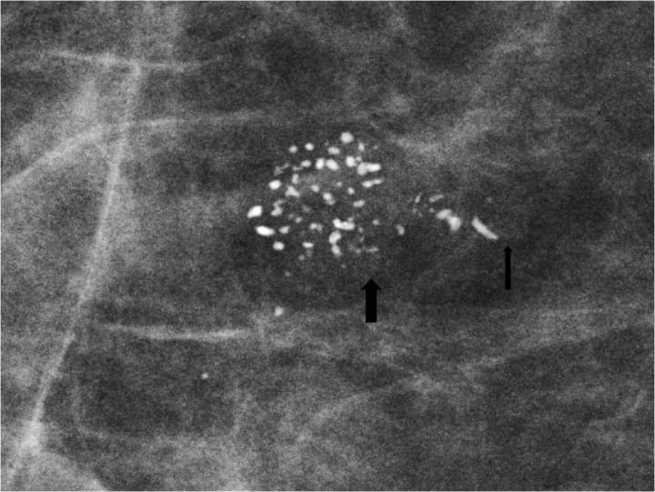 Mamografia com magnificação. A anatomia da unidade ductal lobular terminal é demonstrada nesta visão focada, com o lóbulo e os ácinos preenchidos por calcificações grosseiras e heterogêneas (seta grande) e o ducto terminal preenchido por formas lineares ramificadas de calcificações (seta pequena). Aspecto clássico do Carcinoma Ductal In Situ tipo comedo, BI-RADS 5.